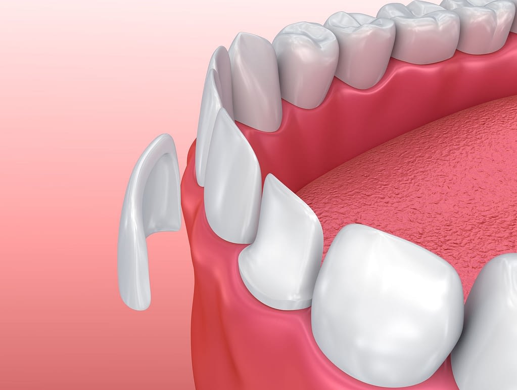 veneers in Turkey