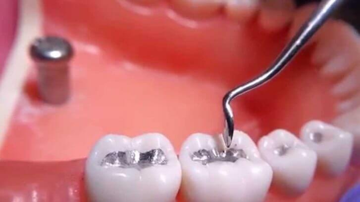 How Does the Process Go Teeth Filling?